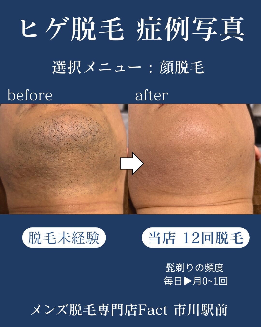8月後半 【全身脱毛 空き状況】 8/14時点